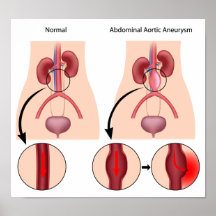 Affiche abdominale d'anévrysme de l'aorte