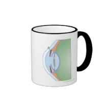 Chirurgie de cataracte mugs à café