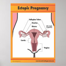 Grossesse ectopique posters