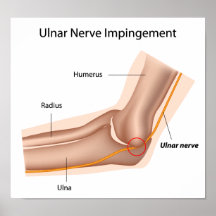 Impact de nerf cubital, syndrome cubital P de tunn Posters