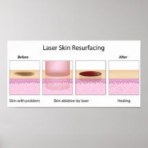 Peau de laser reblanchissant l'affiche de procédur