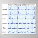 Recherche de ecg posters Cardiologie