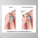 Recherche de épaule posters Anatomie