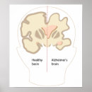Recherche de alzheimer posters Mémoire