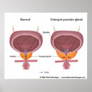 Recherche de urologie Urinaire