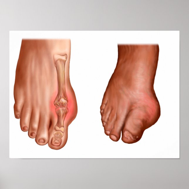 Affiche Anatomie D'Un Pied Gonflé (Devant)