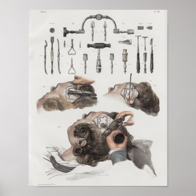 Affiche Brain Surgery Instruments Vintage Anatomy Print (Devant)