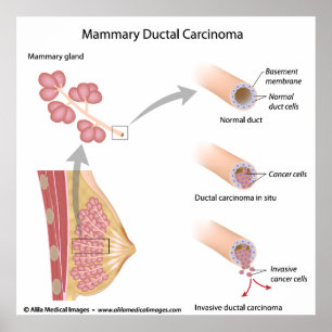 Affiche Cancer du sein : carcinome ductal, schéma labellis
