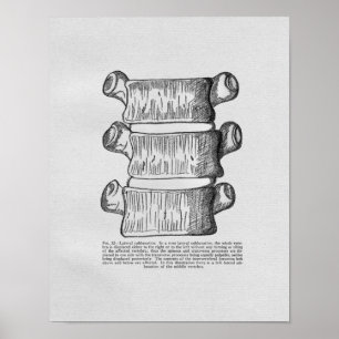 Affiche Chiropractic Vertebral Subluxation Vintage Print