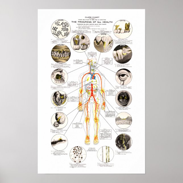 Affiche Clark Dental Health Chart pour dentiste (Devant)
