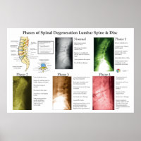 Dégénérescence de la colonne lombaire Chiropratiqu