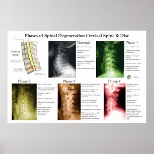 Affiche Dégénérescence de la colonne vertébrale cervicale 