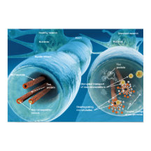 Désintégration des microtubules dans un neurone