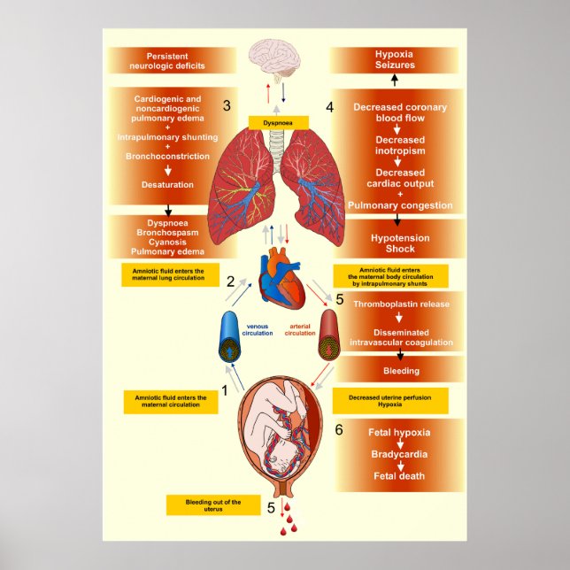 Affiche Diagramme d'un embolisme amniotique de fluides (Devant)