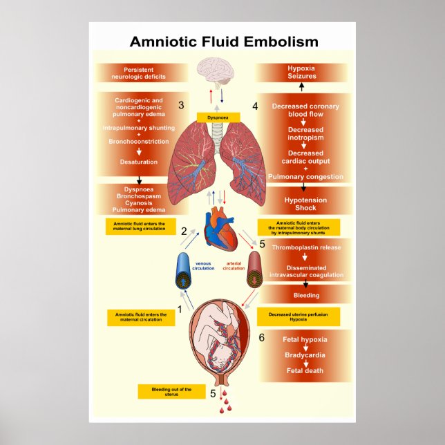 Affiche Diagramme d'un embolisme amniotique de fluides AFE (Devant)