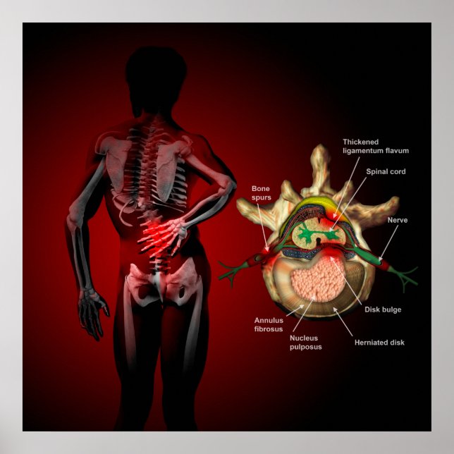 Affiche Douleur du dos (Devant)