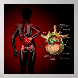 Affiche Douleurs de dos