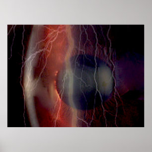 Affiche Éclair sur une cornée déchirée