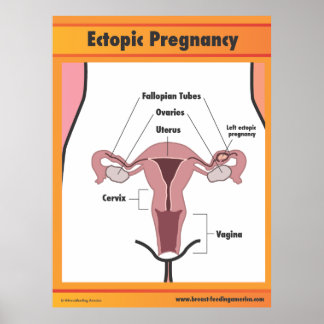 Affiche Grossesse ectopique