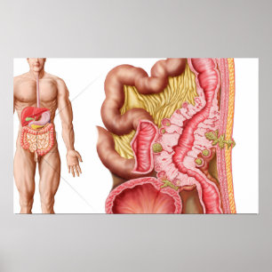 Affiche Illustration de diverticulose dans les deux points