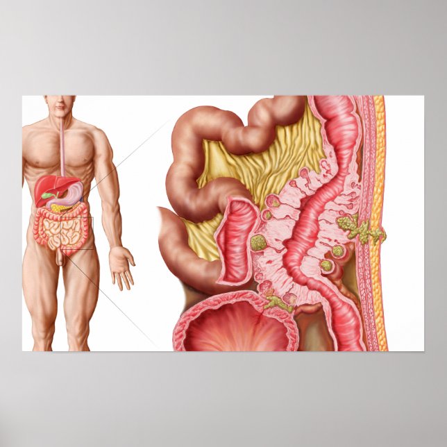 Affiche Illustration De La Diverticulose Dans Le Colon (Devant)