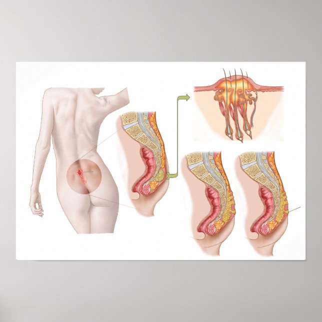 Affiche Illustration Médicale D'Un Cyst Pilonidal (Devant)