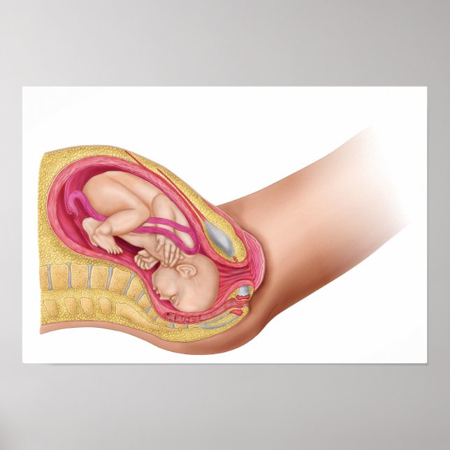 Affiche Illustration Montrant La Livraison Du Foetus 2 (Devant)