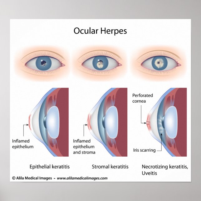 Affiche Infection à l'herpès oculaire, diagrammes étiqueté (Devant)