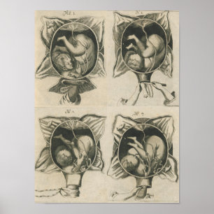 Affiche Justine Siegemund Cour - Grossesse de naissance d'