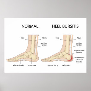 Affiche La difformité de Haglund