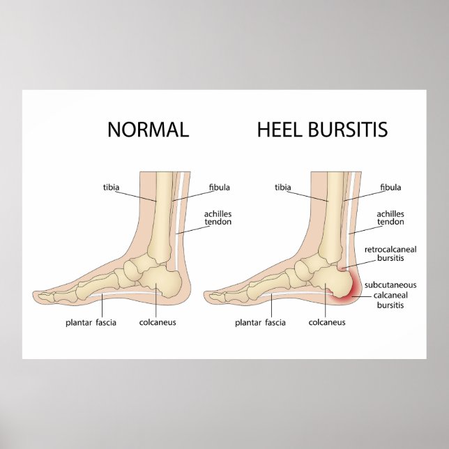 Affiche La difformité de Haglund (Devant)