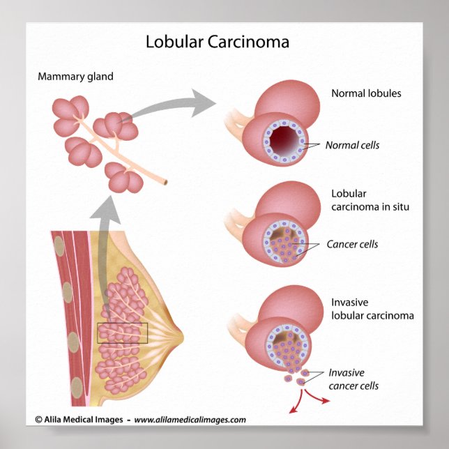 Affiche Lobular breast cancer, labeled diagram. (Devant)