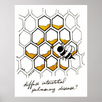 Affiche Maladie pulmonaire interstitielle diffuse