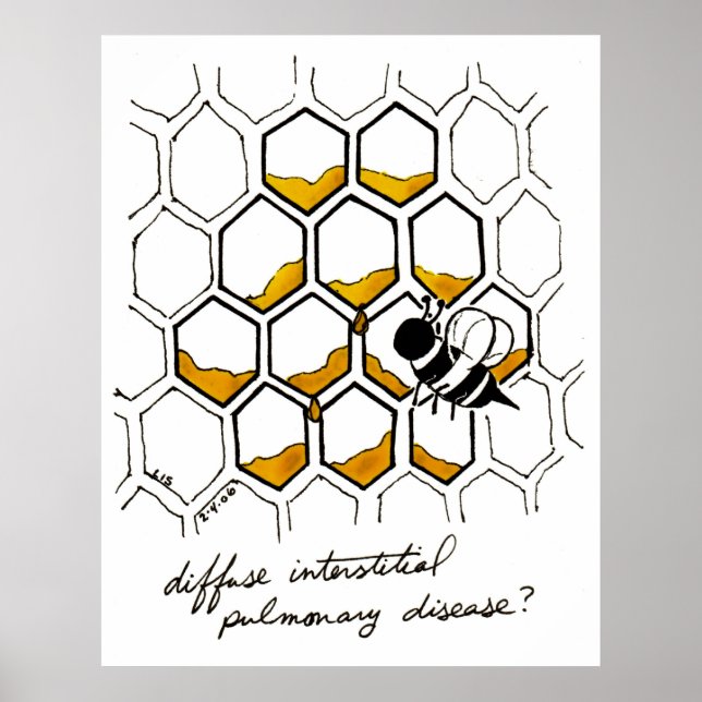 Affiche Maladie pulmonaire interstitielle diffuse (Devant)