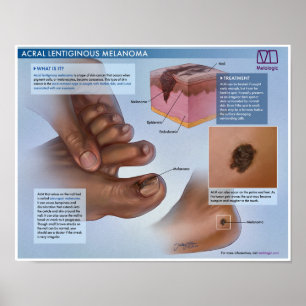 Affiche Mélanoma Médicale Melalogique Acral