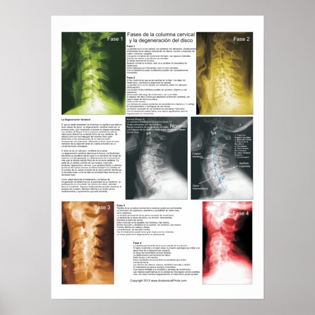 Affiche Phases Espagnoles Cervical Spinal Degeneration Pos (Devant)