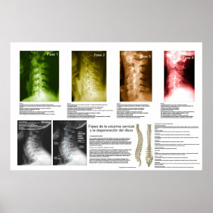 Affiche Phases Espagnoles Cervical Spinal Degeneration Pos