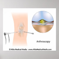 Schéma d'arthroscopie du genou.