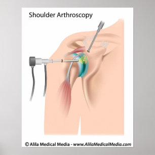 Affiche Shoulder arthroscopy diagram.