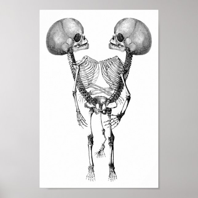 Affiche Siamese joint Twins Anatomy Skeletons art (Devant)