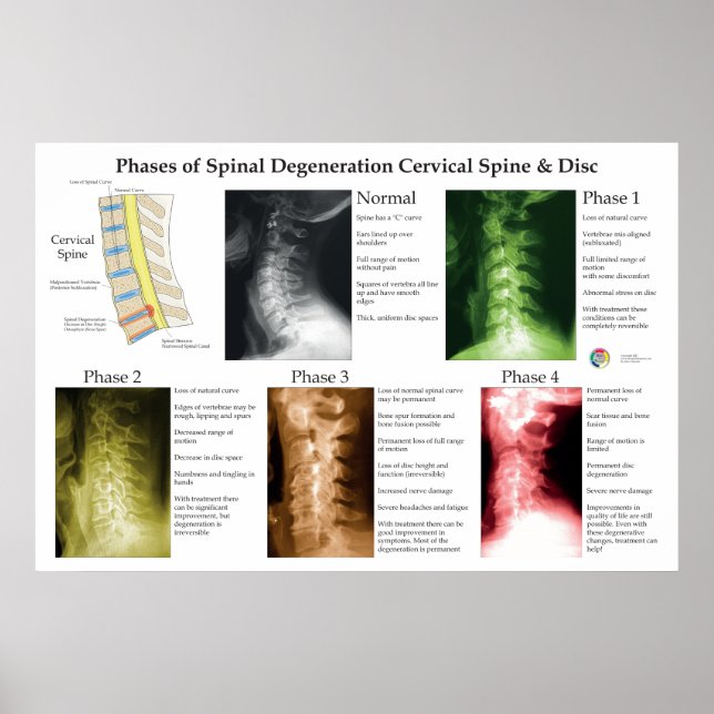 Affiche Spinal Degeneration Cervical Spine Chiropractic (Devant)