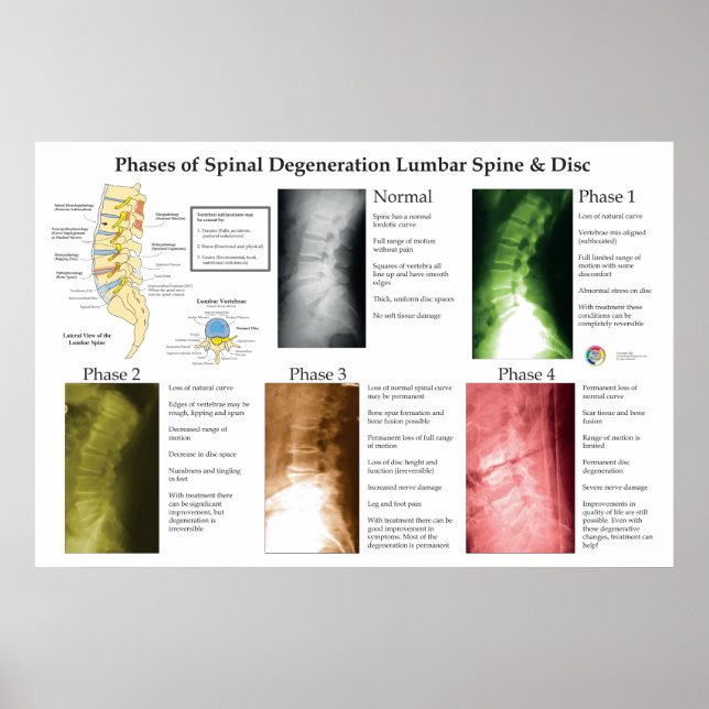 Affiche Spinal Degeneration Lumbar Spine Chiropractic (Devant)
