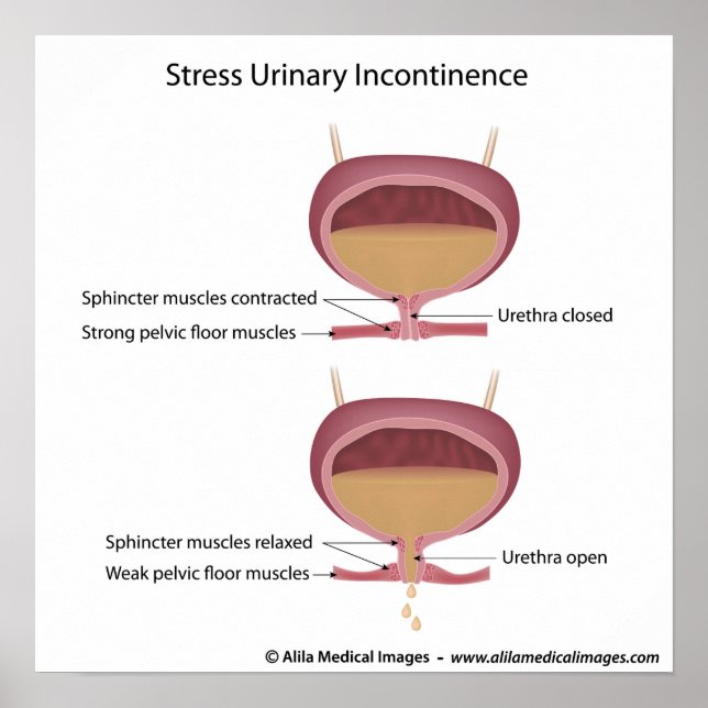 Affiche Stress incontinence urinaire chez les femmes. (Devant)
