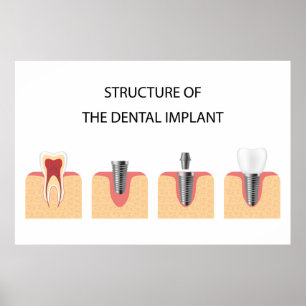 Affiche Structure de l'implant dentaire