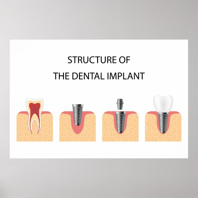 Affiche Structure de l'implant dentaire (Devant)