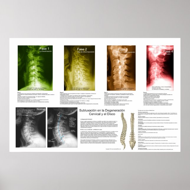 Affiche Subluxation Espagnole Cervical Spinal Degeneration (Devant)