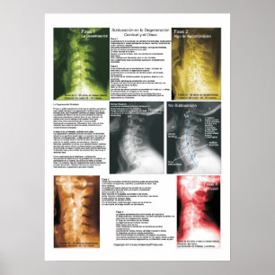 Affiche Subluxation Espagnole Cervical Spinal Degeneration