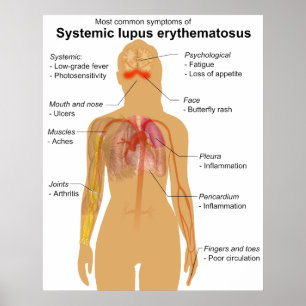 Affiche Symptom Graphique du lupus érythémateux systémique