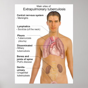 Affiche Symptômes principaux de la tuberculose extrapulmon