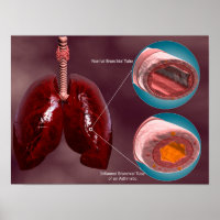 Trachea Transsection Avec Poumons